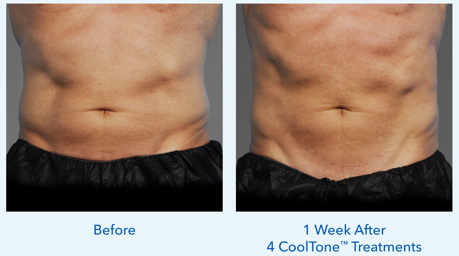 Before and After CoolTone™ Treatments