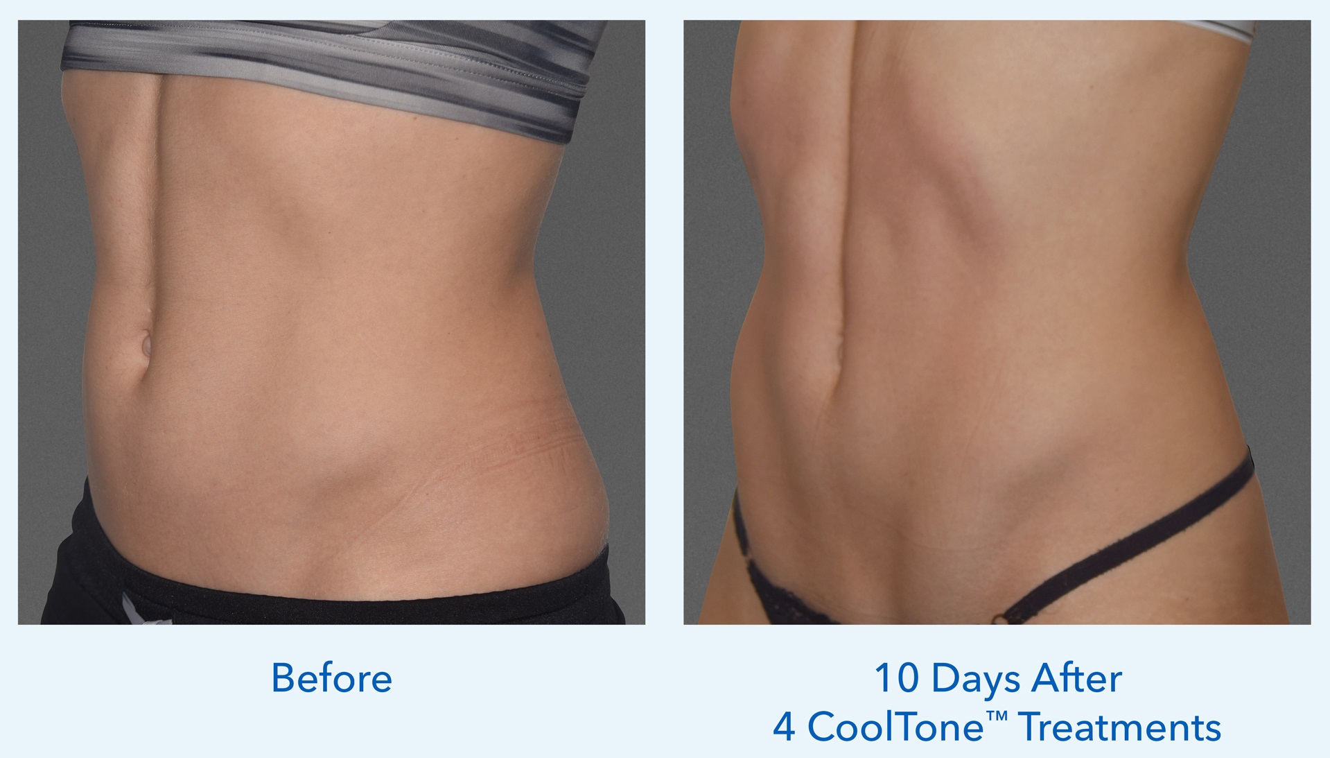 Before and After CoolTone™ Treatments
